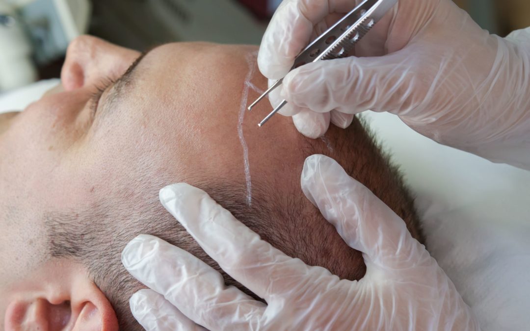 The ARTAS 9x is among the most advanced hair restoration technology tools available. This image depicts a man beginning a hair transplant procedure.